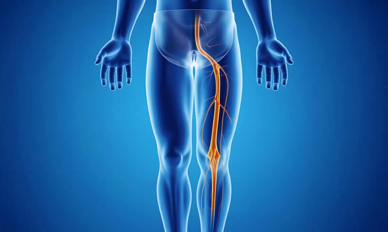 Pain down your leg? 6 signs you may have a pinched nerve or herniated disc